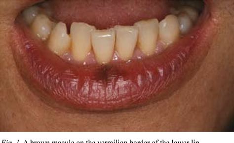 [PDF] Labial melanotic macule diagnosed by dermoscopy. | Semantic Scholar