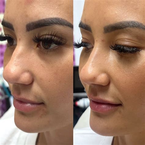 The nose thread lift as the new nonsurgical Rhinoplasty - Hush LA Medspa