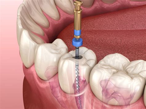 What are the Alternatives to Root Canal Treatment?