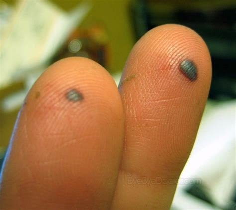 Infected Blood Blister On Finger