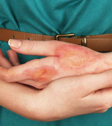 Ice Burn: Causes, Symptoms, And Treatment