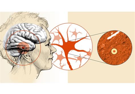 Leading NIH's Lewy body dementia initiative - Mayo Clinic