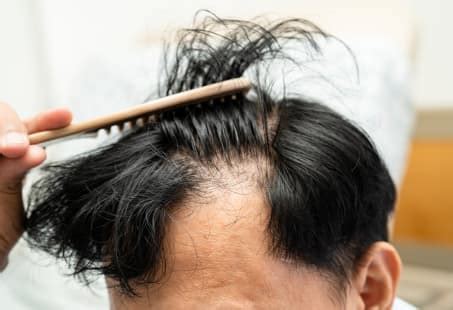 Ringworm Hair Loss: Signs, Causes & Treatments | Longevita