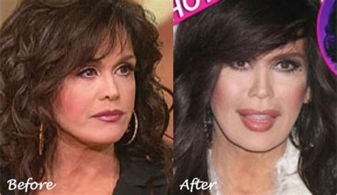 Marie Osmond Plastic Surgery: Reinventing a Glamorous Look