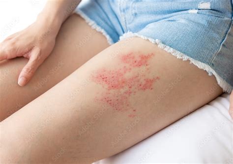 Shingles | Causes, Symptoms, Stages, Home Remedies & Prevention - Myhealthopedia