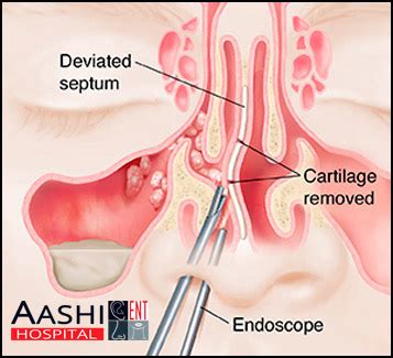 Functional Endoscopic Sinus Surgery - Aashi ENT Hospital