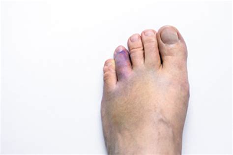 Is My Toe Broken? - Blog