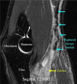 RadiologySpirit: Elbow: Biceps Tendon Rupture on MRI Scan