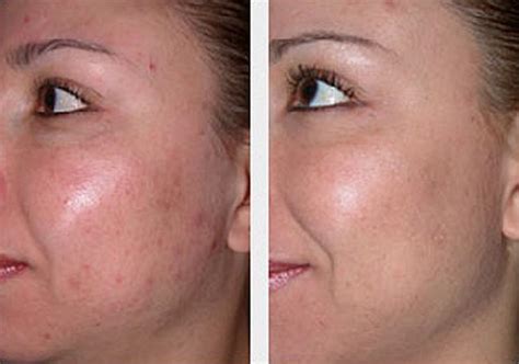 Microdermabrasion, safe and controlled skin rejuvenation