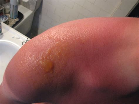 File:Sunburn blisters.jpg - Wikipedia