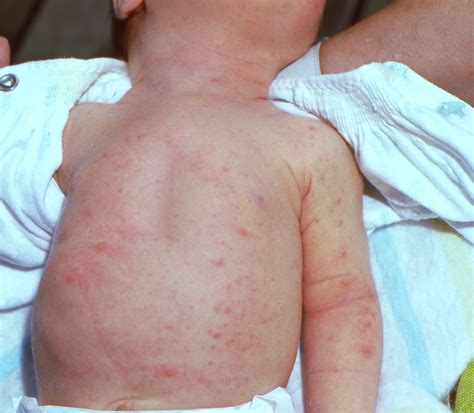 Common Newborn Rashes - Pediatrics West