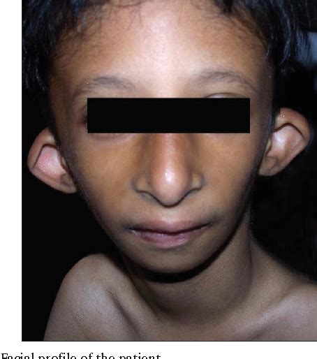 Figure 1 from Anesthetic management of a child with Seckel syndrome for multiple extractions and ...