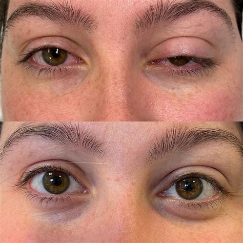 Understanding Eyelid Drooping: Causes, Symptoms, and Treatment Options