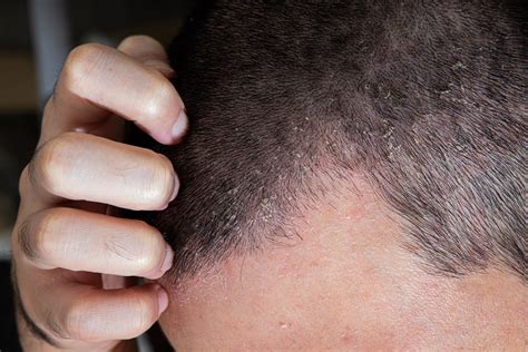 HAIR LOSS OR NOT, LEARN HOW TO PROTECT YOUR SCALP