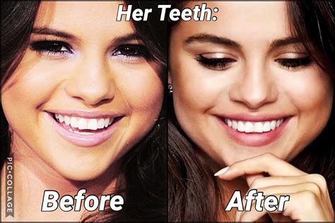 The 411 Dirt: Did You Know Selena Gomez Has VENEERS?! *2019*