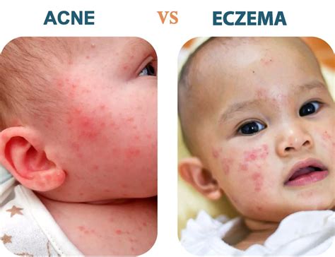 Baby Acne vs. Eczema: Understanding The Difference