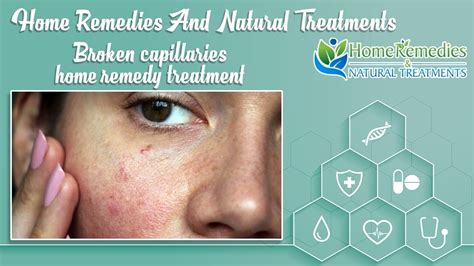 Broken capillaries home remedy | How do you get rid of broken ...