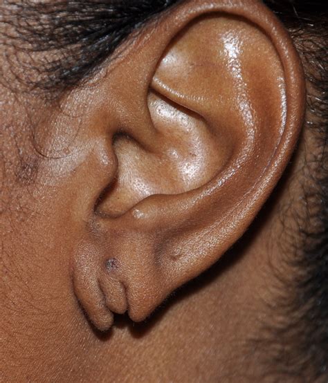 Repair of Torn or Split Earlobes under Local Anesthesia - Explore Plastic Surgery