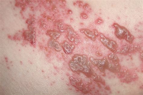 Bacterial Rash On Buttocks