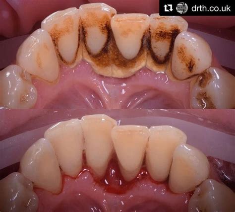 #beforeafter a scale and clean. What a difference #hygiene makes! Tag someone who needs this ...