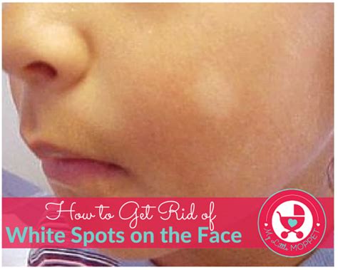 How to get rid of white spots on the face-5 Most Effective Solutions ...