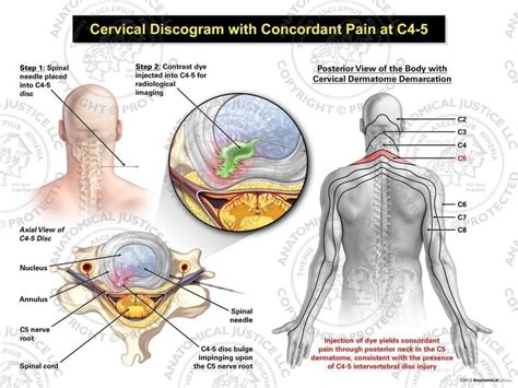 Male Right Cervical Discogram with Concordant Pain at C4-5