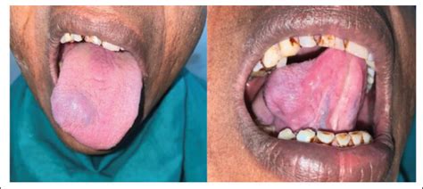 Cavernous Hemangioma of Tongue in an Adult Male: A Rare Case Report ...