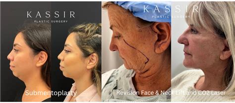 How does a submentoplasty differ from a necklift? — Kassir Plastic Surgery in NY and NJ