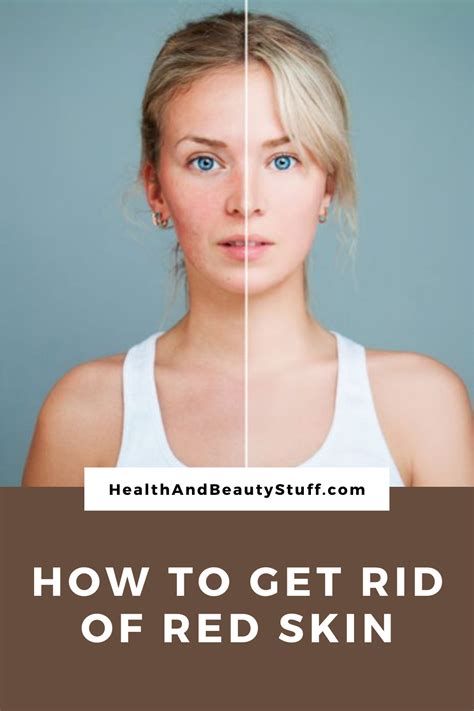 How To Get Rid of Red Skin | Men health tips, Skin, Health tips for women