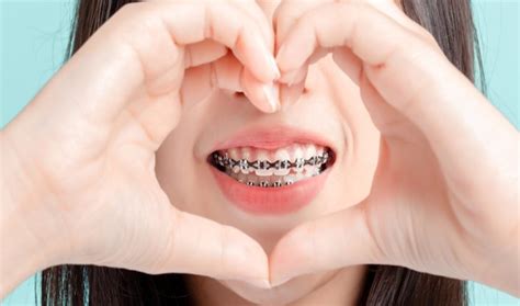 Dental Braces: Types & How Much Do They Cost