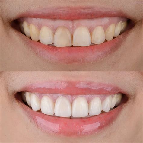 Laser Gum Contouring For a Gummy Smile Makes Teeth Appear Longer