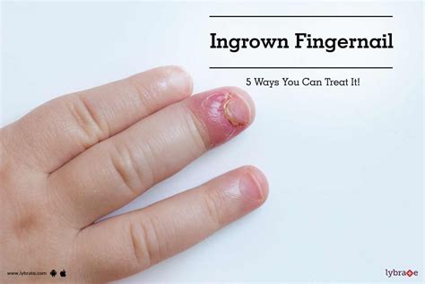 Ingrown Fingernail - 5 Ways You Can Treat It! - By Dr. Sruthi Gondi | Lybrate