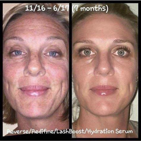 hydroquinone under eyes before and after - klaramad