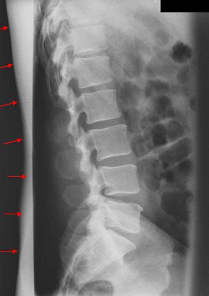 lumbar vertebrae x ray - Google Search | spines | Pinterest