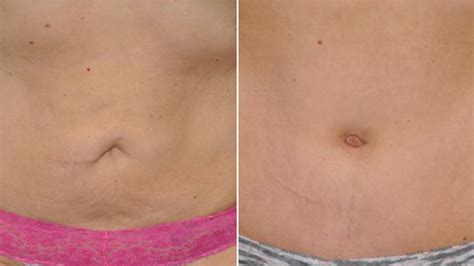 Belly button makeovers: Doctors help shape the 'perfect' navel | Belly button, Doctor help, Belly