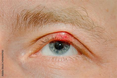 Eye sick, eyelid sick. Demodicosis mite diseas, demodex. Chalazion on eyelid. Eye treatment ...