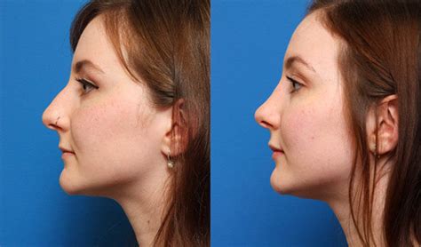 Nose job: How to prepare for it? - Dr. Ali Gaber, plastic surgeon and body sculpting specialist