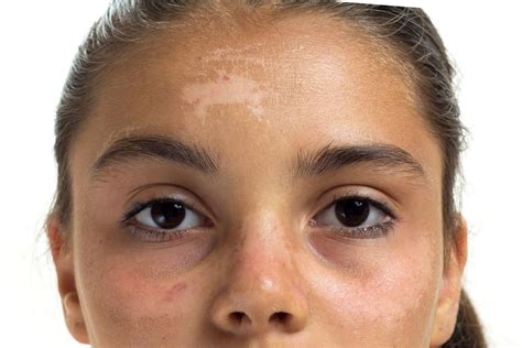 How to Treat Sunspots on Your Face: A Comprehensive Guide