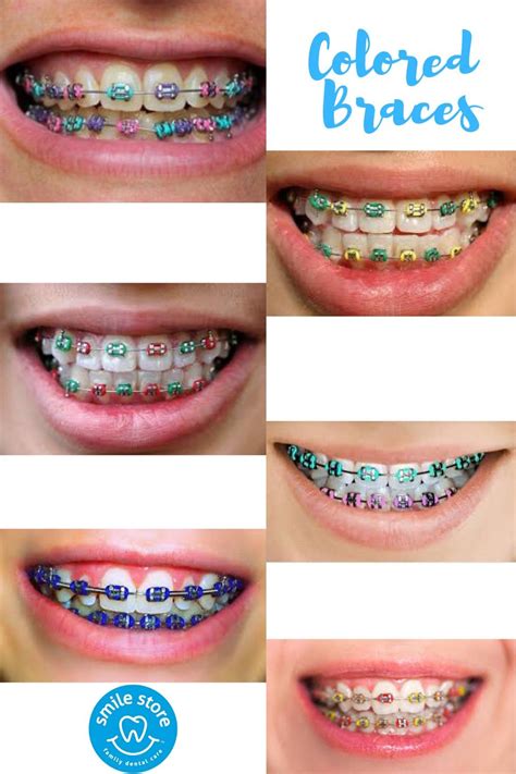 Cool Braces Colors Ideas – Warehouse of Ideas