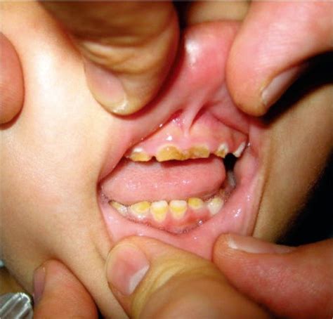 Deciduous teeth at 2 yr of age. The color of the upper teeth was more... | Download Scientific ...