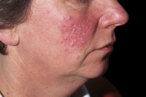 Rosacea On Chest