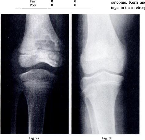 Knee Tuberculosis Of The Bone - cloudshareinfo