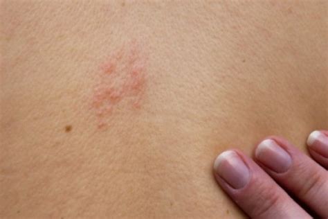 Remedies for Shingles Pain | ThriftyFun