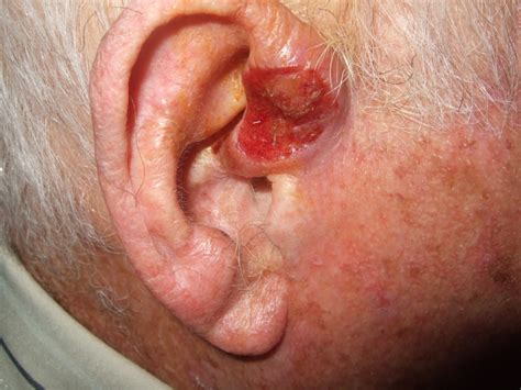 Erythroplasia Of Queyrat Symptoms