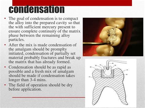 procedure for amalgam restoration