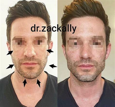 ☝️MASCULINISATION (7ml) Before and 15 minutes after cheeks, chin ...