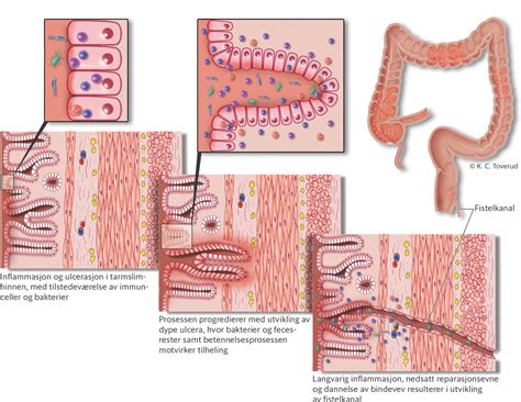 Medikamentell behandling ved fistulerende Crohns sykdom | Tidsskrift for Den norske legeforening