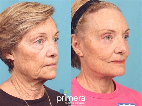 Mini Facelift Before and After Pictures Case 810 | Orlando, Florida ...