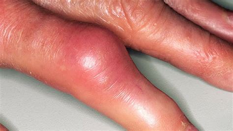 Gout arthritis Pictures HD - Signs, Symptoms, Images, Photos and ...