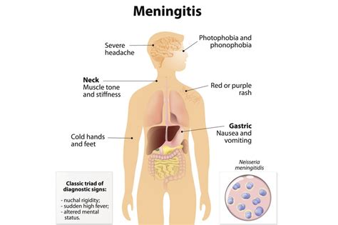 The 3 Pathogens That Cause Meningitis